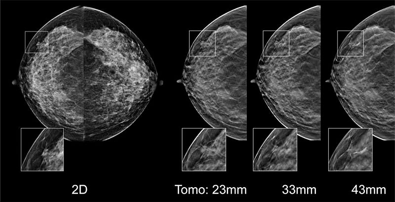 Breast Tomosynthesis